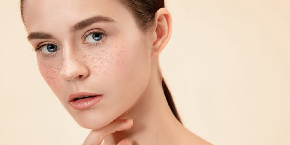 Freckles-Treatment