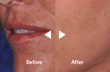 Acne Scar Removal in Jaipur - Dr. Dhabhai Skin Clinic