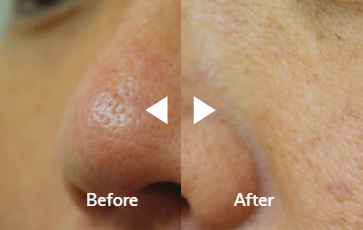 Microneedling for Acne Scars