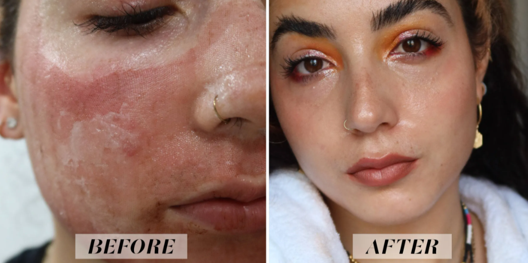 Photofractional Resurfacing